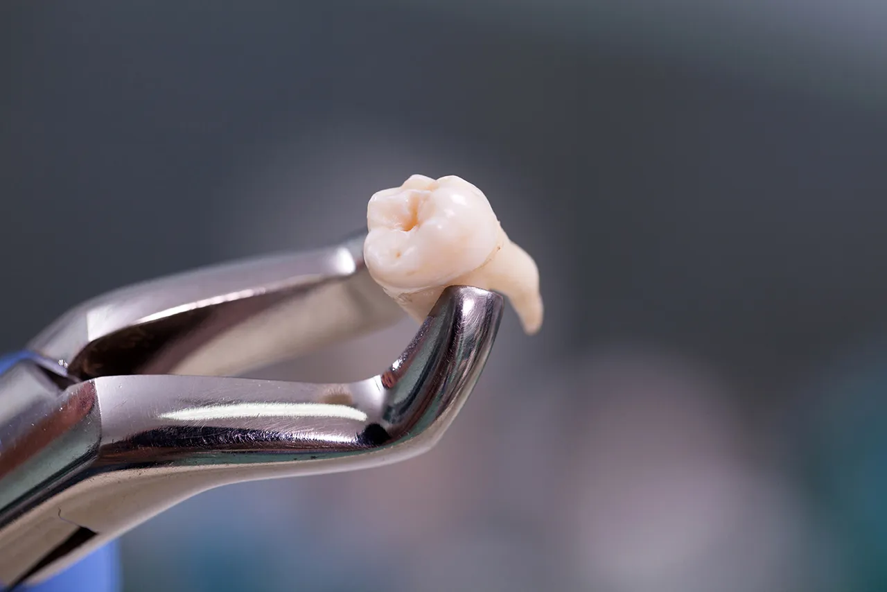 Tooth Extractions in Somerset, NJ | Safe, Gentle Removal by Trusted Experts